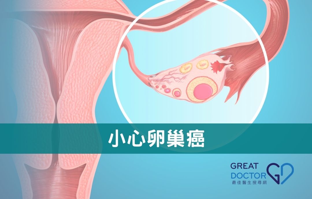 小心卵巢癌