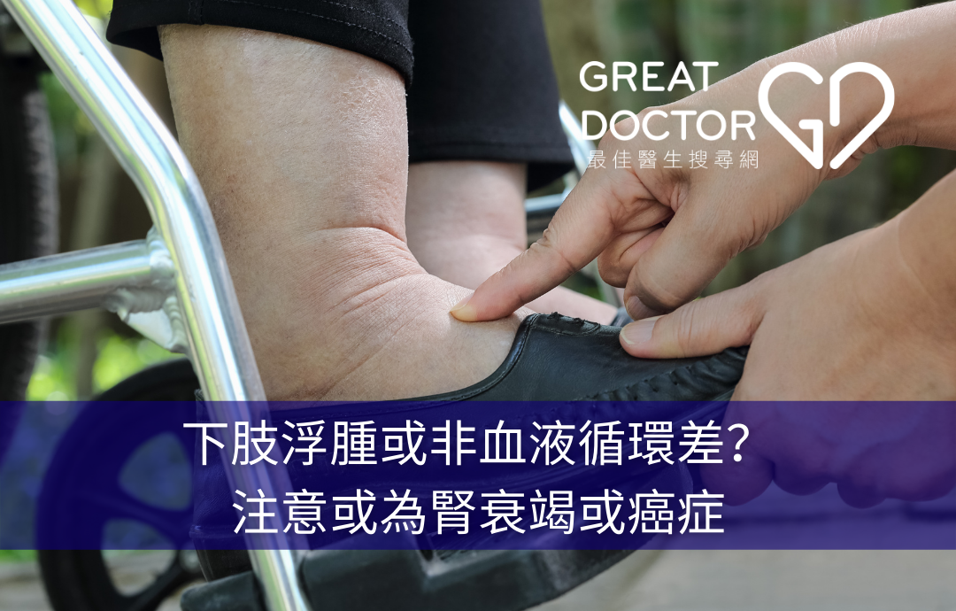 下肢浮腫或非血液循環差？注意或為腎衰竭或癌症