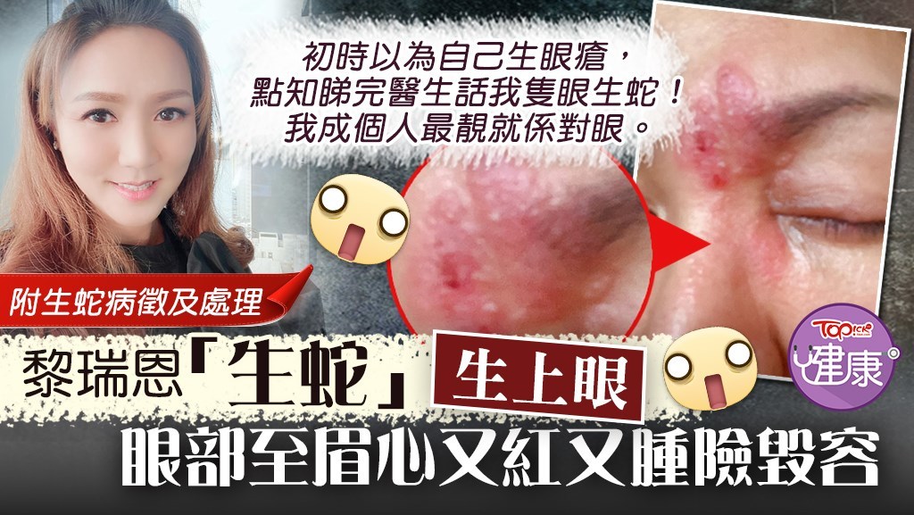 【眼生蛇】黎瑞恩「生蛇」生上眼！眼部至眉心又紅又腫險毀容