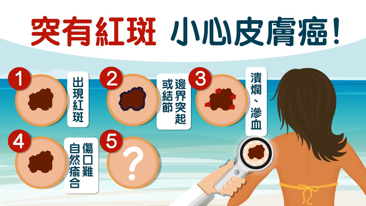 皮膚白屬高危？打傘塗防曬邊樣好？6大特徵有樣睇