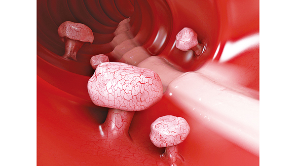 大便隱血的幾個可能性