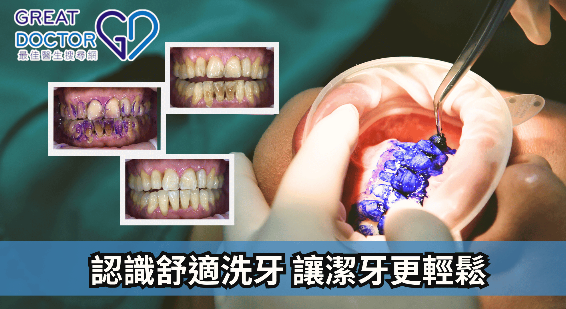 認識舒適洗牙 讓潔牙更輕鬆