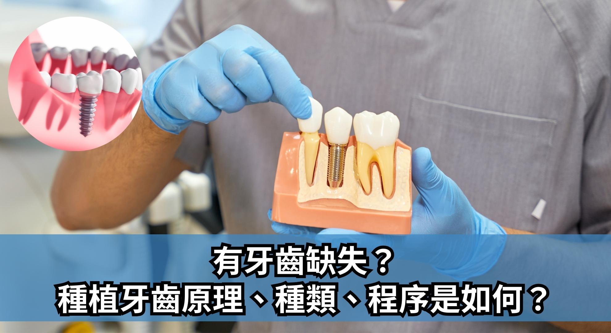 有牙齒缺失？種植牙齒原理、種類、程序是如何？