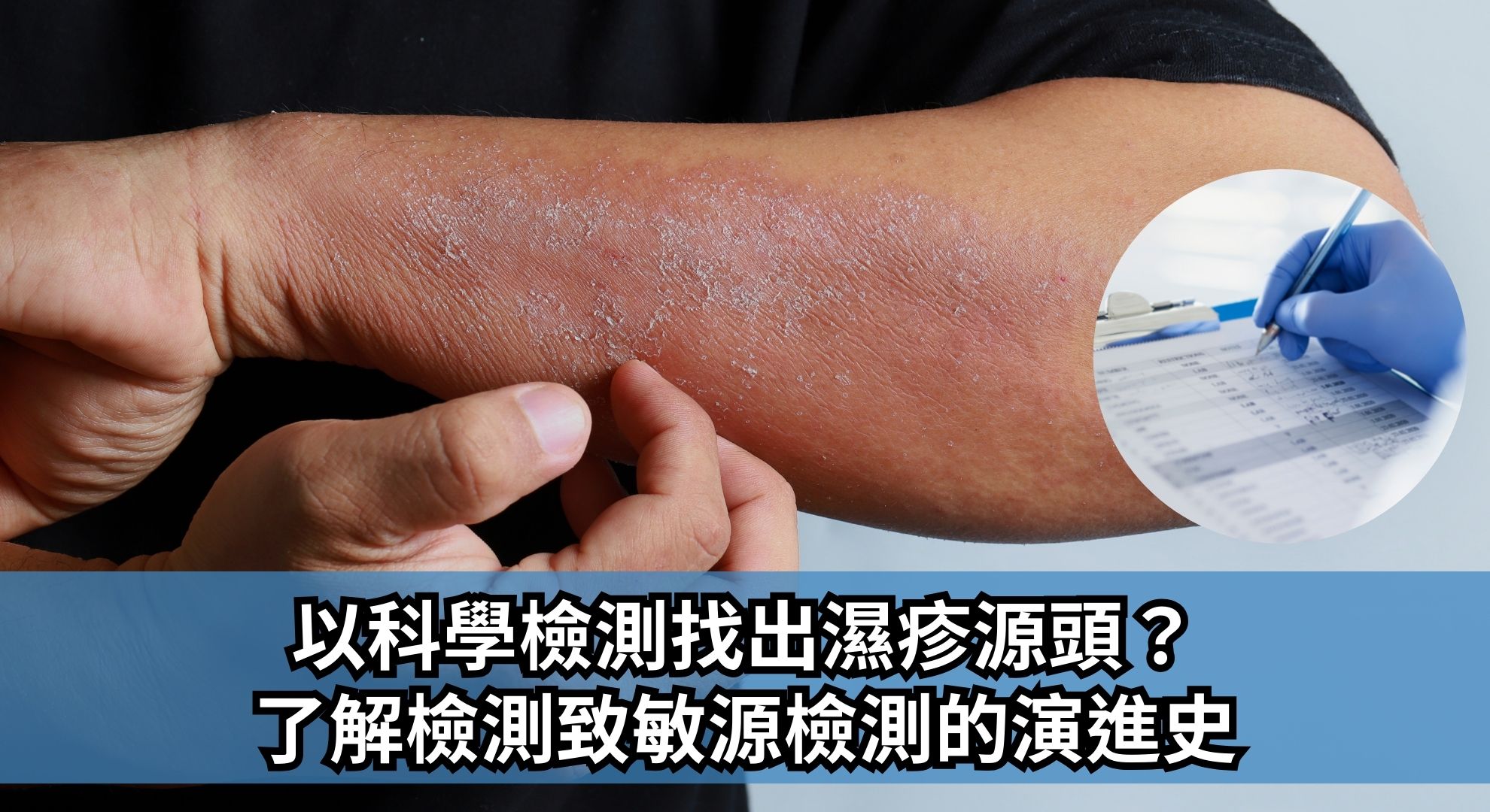以科學檢測找出濕疹源頭？ 了解檢測致敏源檢測的演進史