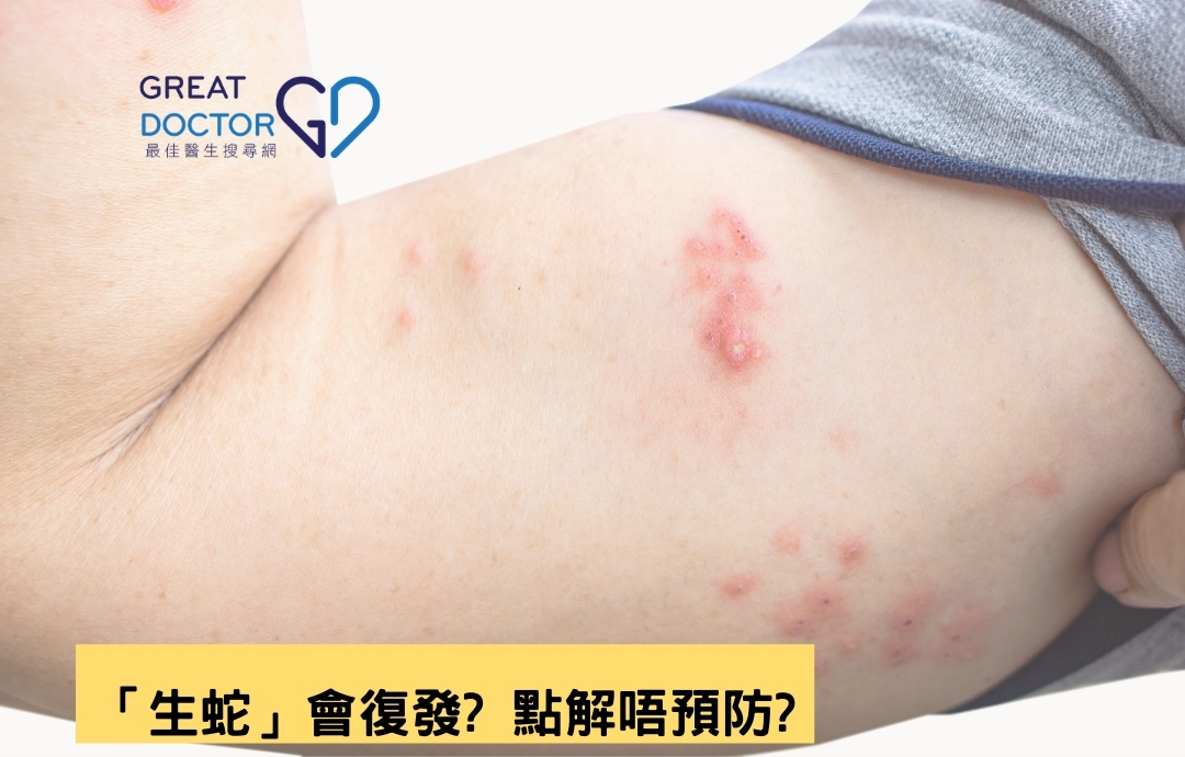 「生蛇」會復發? 點解唔預防?