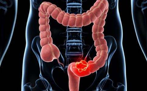 什麼是大腸癌?