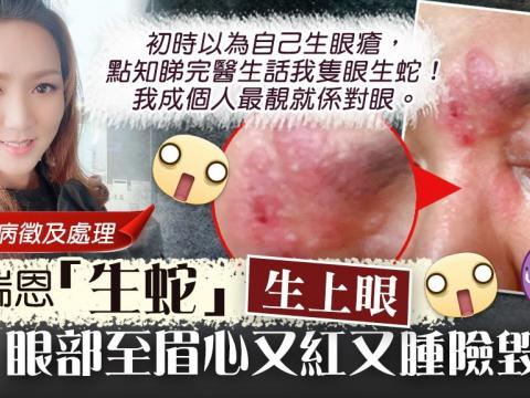 【眼生蛇】黎瑞恩「生蛇」生上眼！眼部至眉心又紅又腫險毀容