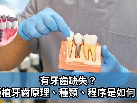 有牙齒缺失？種植牙齒原理、種類、程序是如何？