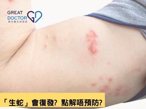 「生蛇」會復發? 點解唔預防?